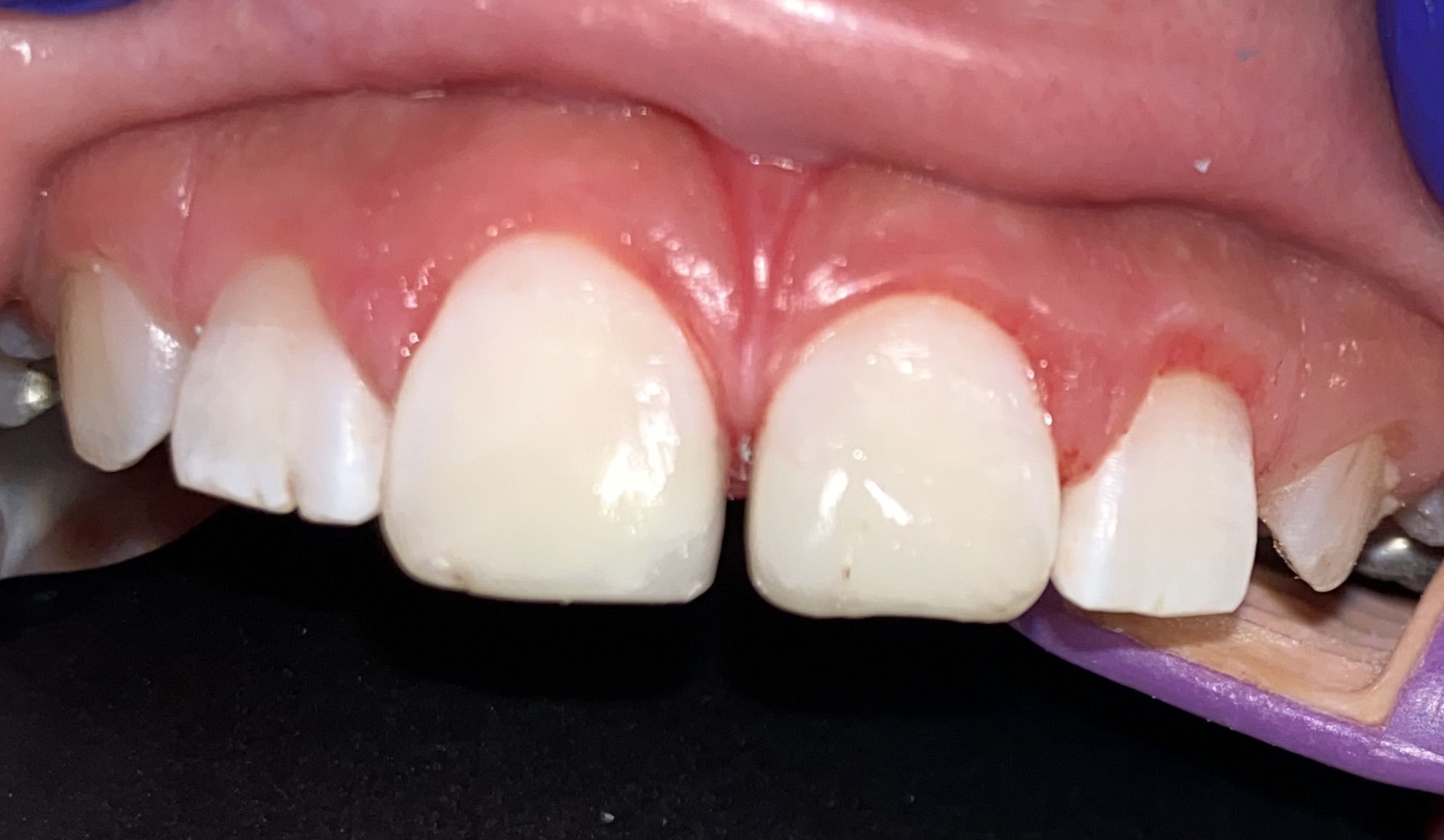 pediatric incisors after