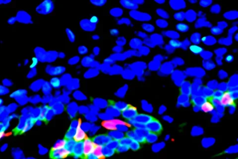 Head and neck cancer stem cells (red) expressing the CD276 gene (green) are found in high proportions at the periphery of tumor bodies; CD276 provides protection against cancer-fighting T cells to stem cells and interior tumor cells (blue).
