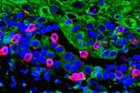 An immunofluorescent image that shows T cells (red) migrating to tumor tissues to (green) after the combination treatment of anti-PD1 and BMI1 inhibitor.