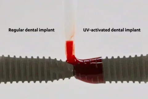 Two dental implants side-by-side