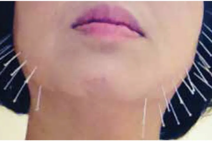 acupuncture needles neck chin