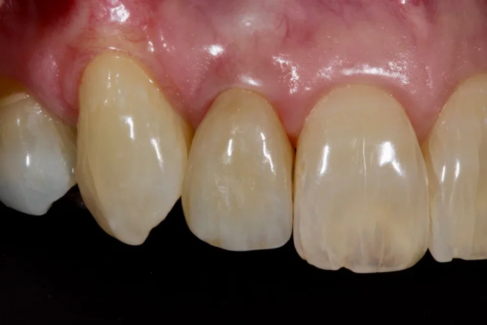 Close up view of the upper teeth and gumline.