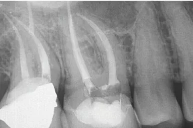endodontic tooth radiograph