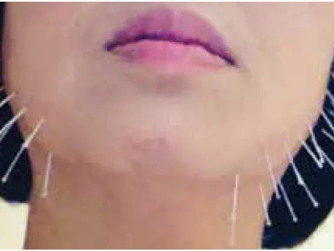 acupuncture needles neck chin
