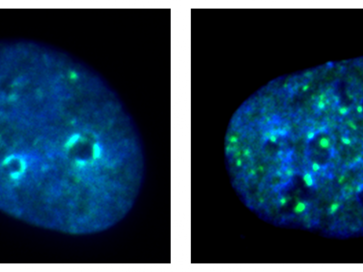 Immunofluorescence images of cancer cells with and without KDM4A