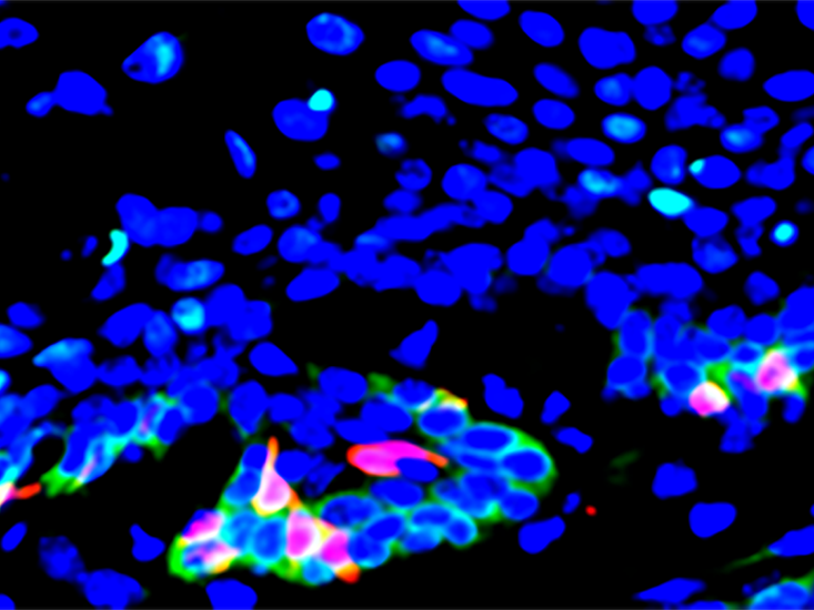 Head and neck cancer stem cells (red) expressing the CD276 gene (green) are found in high proportions at the periphery of tumor bodies; CD276 provides protection against cancer-fighting T cells to stem cells and interior tumor cells (blue).