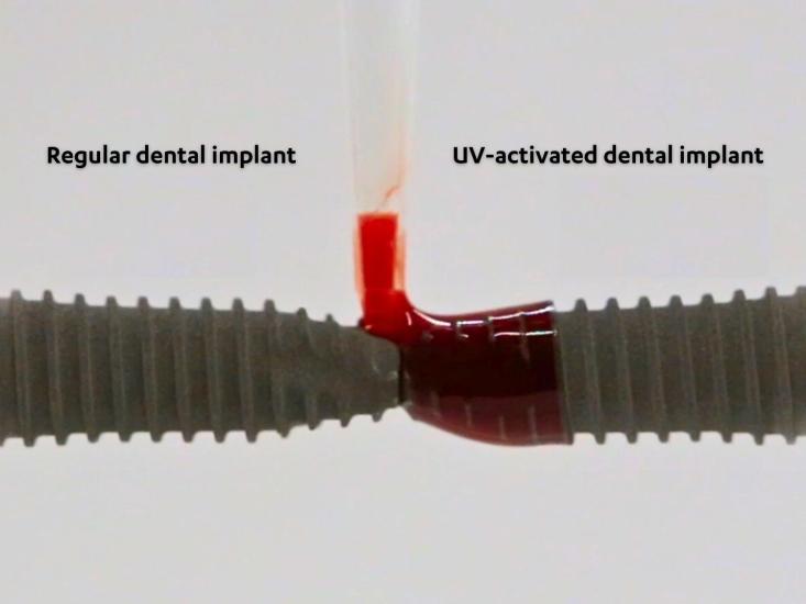 Two dental implants side-by-side