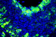 A microscope image shows a metastasized lymph node in a person with on-small cell lung cancer.