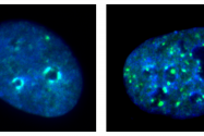 Immunofluorescence images of cancer cells with and without KDM4A