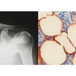 By identifying the underlying factors leading to bone loss and osteoporosis, UCLA dentist-scientists hope to pave the way to new treatments