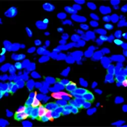 Head and neck cancer stem cells (red) expressing the CD276 gene (green) are found in high proportions at the periphery of tumor bodies; CD276 provides protection against cancer-fighting T cells to stem cells and interior tumor cells (blue).