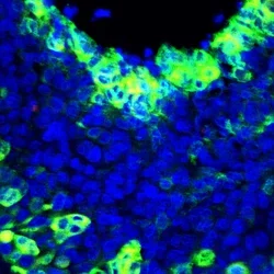 A microscope image shows a metastasized lymph node in a person with on-small cell lung cancer.