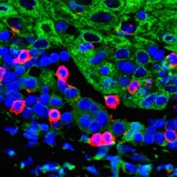 An immunofluorescent image that shows T cells (red) migrating to tumor tissues to (green) after the combination treatment of anti-PD1 and BMI1 inhibitor.