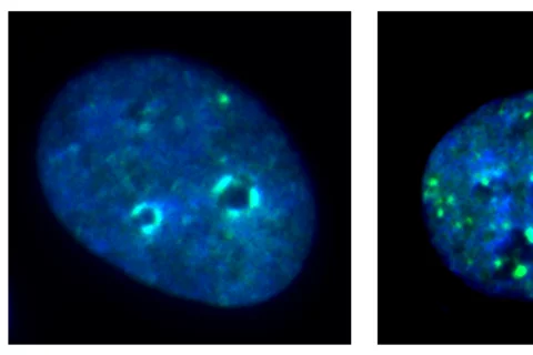 Immunofluorescence images of cancer cells with and without KDM4A