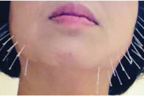 acupuncture needles neck chin