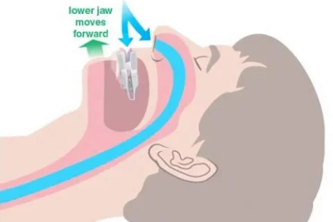 mandibular advancement device airway graphic