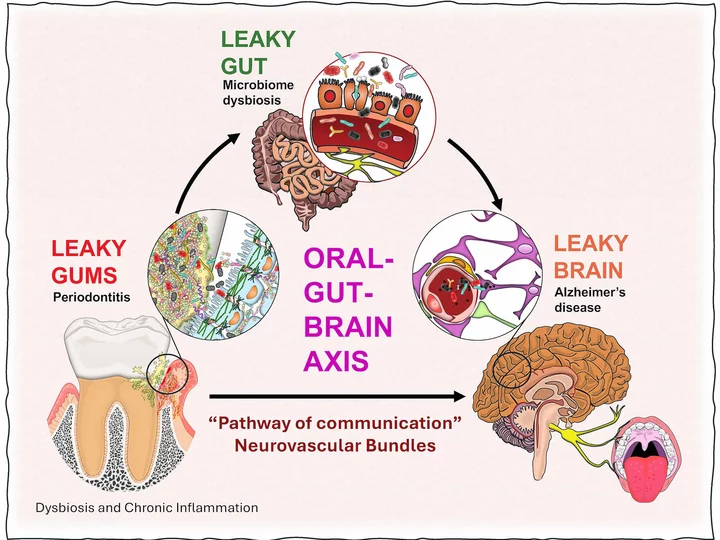 medical graphic, reading from top-to-bottom: LEAKY GUT Microbiome dysbiosis LEAKY GUMS Periodontitis AMARA. ORAL- GUT- BRAIN AXIS LEAKY BRAIN Alzheimer's disease "Pathway of communication" Neurovascular Bundles Dysbiosis and Chronic Inflammation